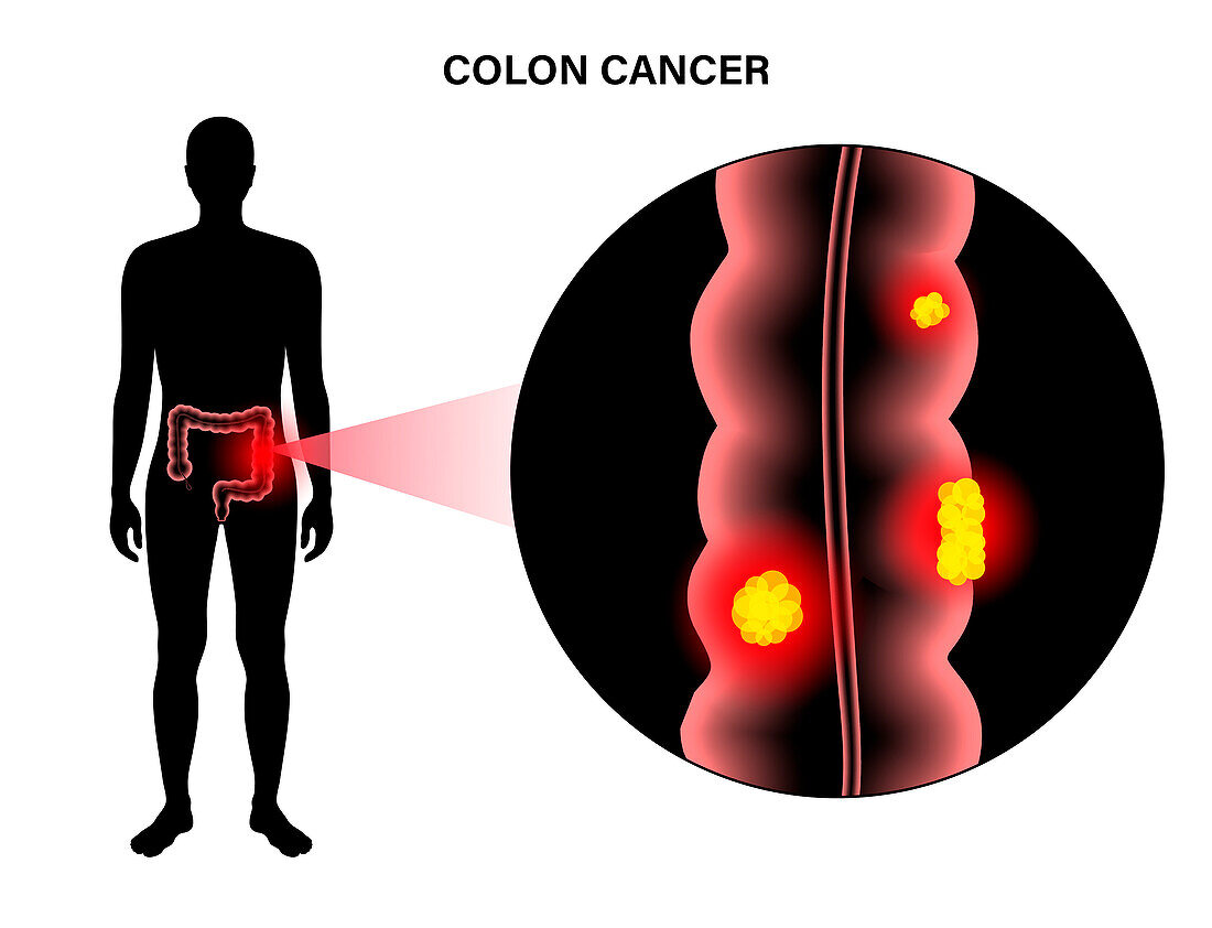Colorectal cancer, illustration