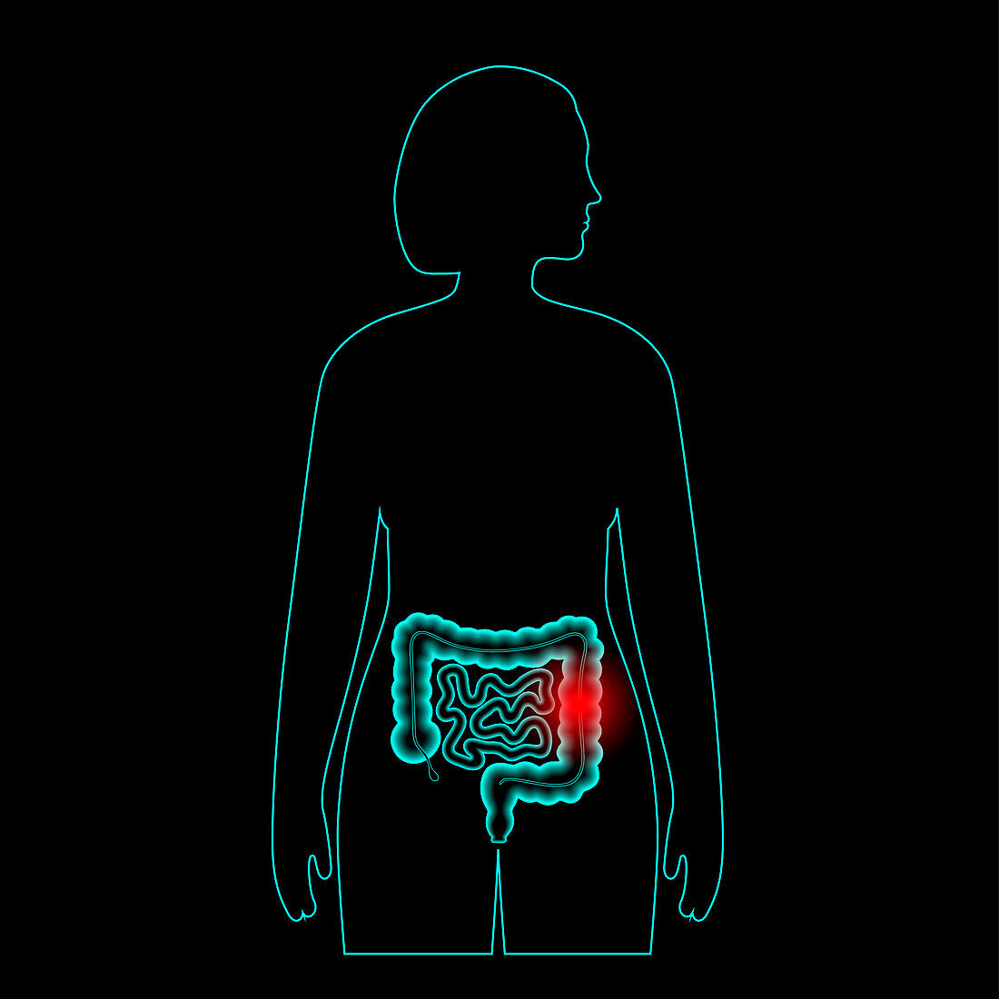 Intestine disease, illustration