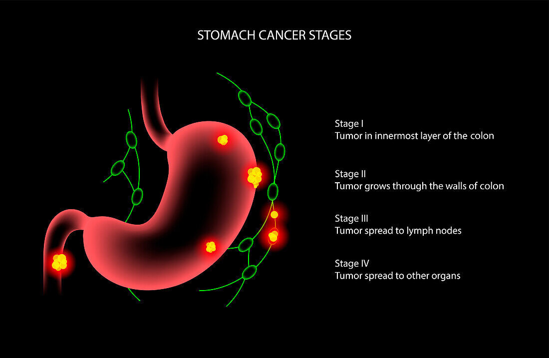 Stomach cancer, illustration