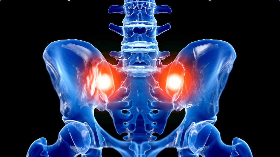 Pain in the sacroiliac joint, illustration