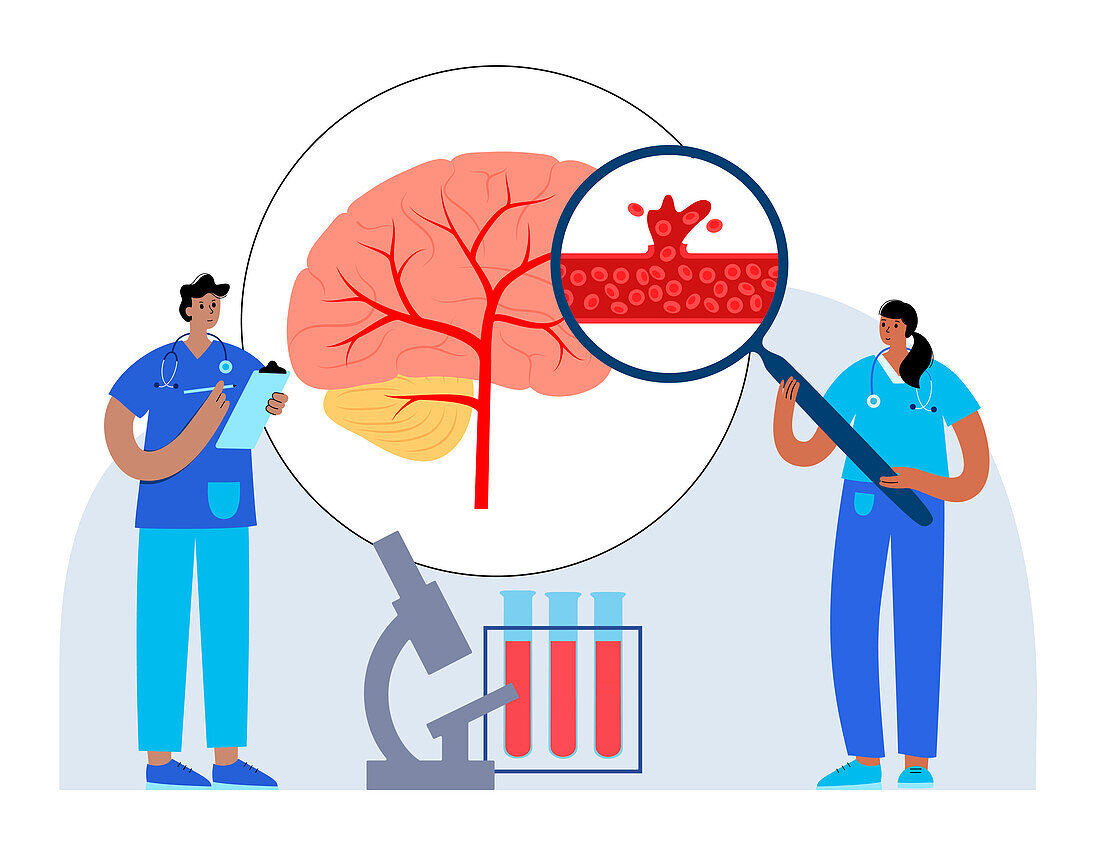 Haemorrhagic stroke research, illustration