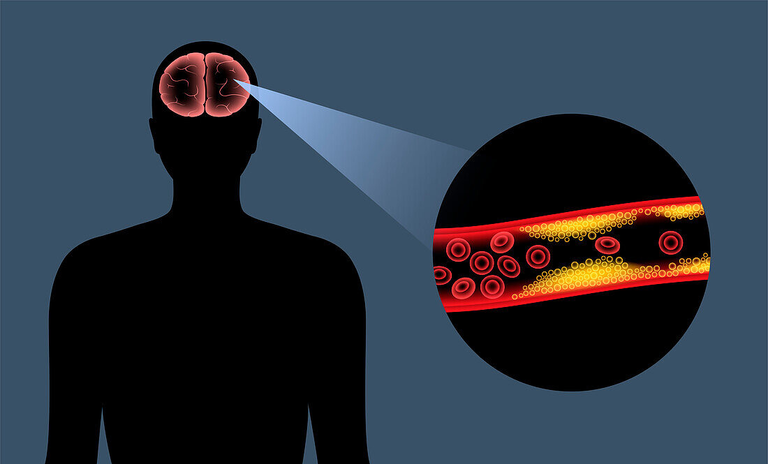 Ischaemic stroke, illustration