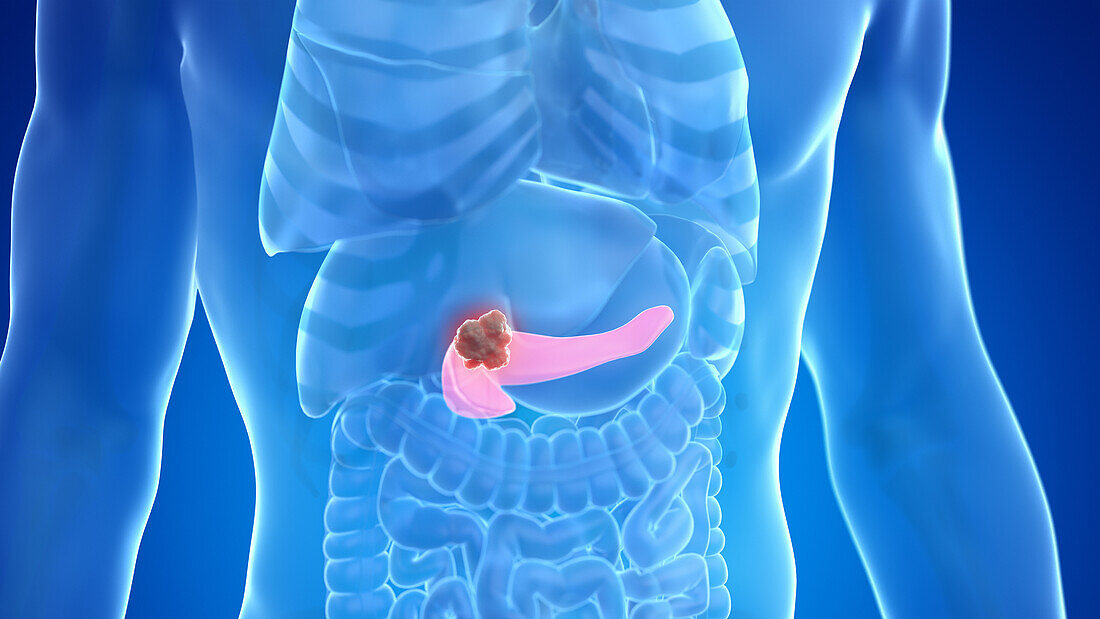 Pancreas cancer, illustration