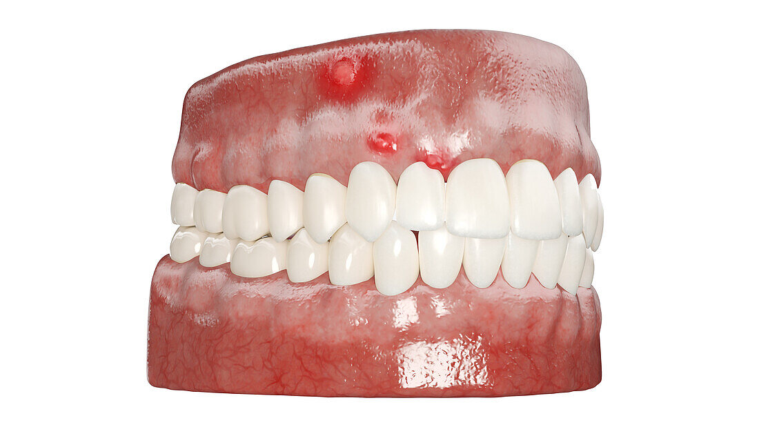 Dental abscess, illustration