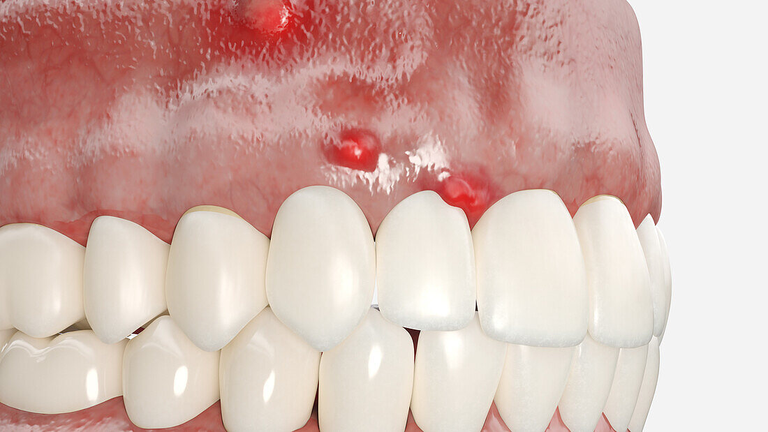 Dental abscess, illustration