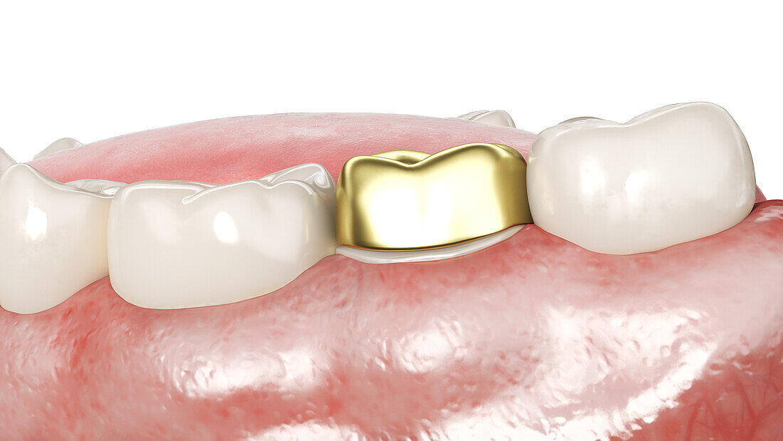 Dental crown, illustration