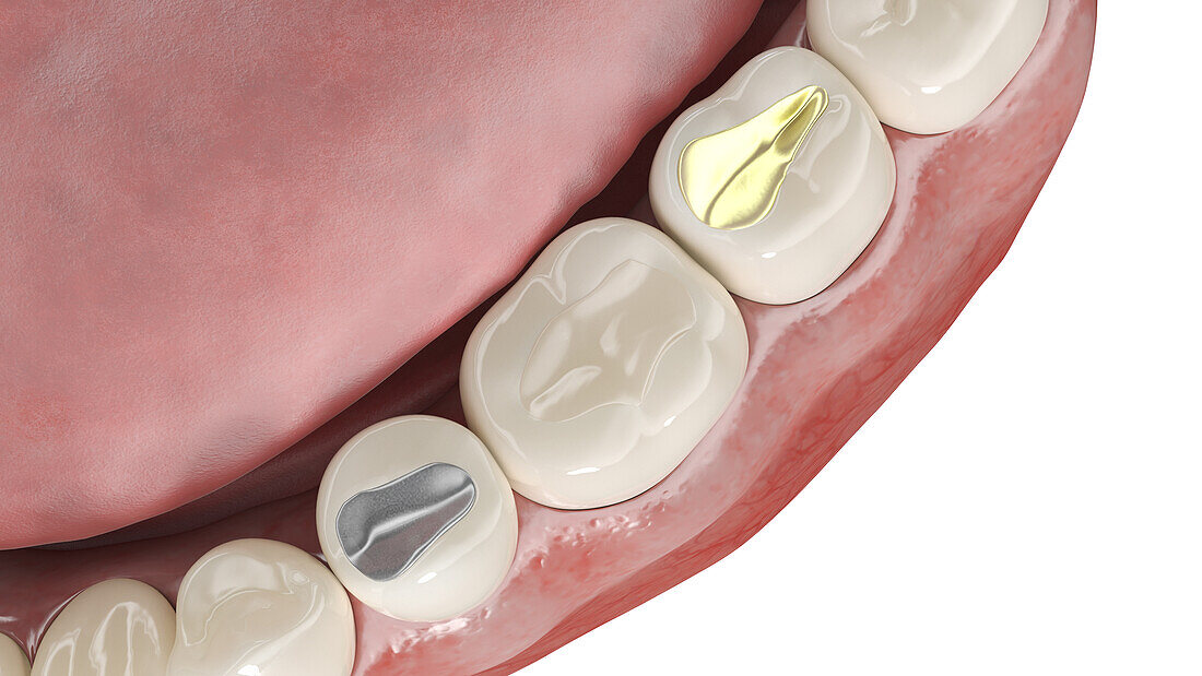 Different dental fillings, illustration