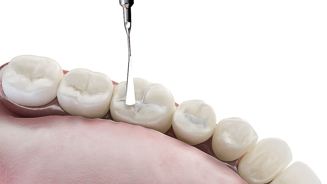 Dental fissure filling, illustration