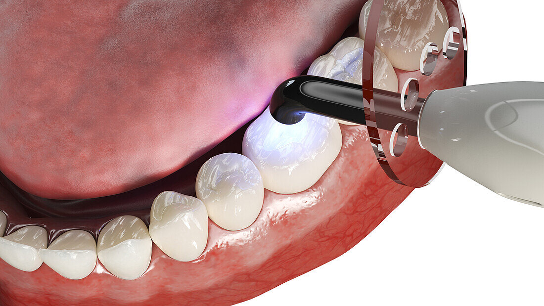 Dental polymerisation, illustration
