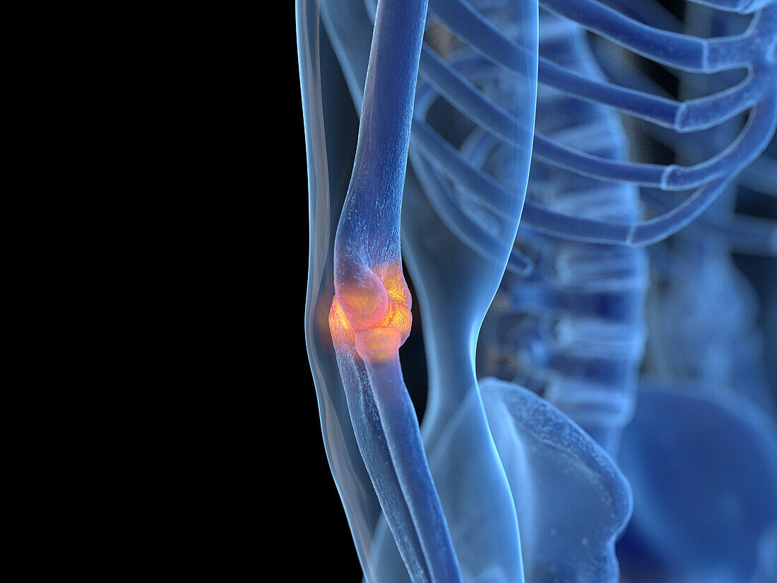 Inflamed elbow joint, illustration