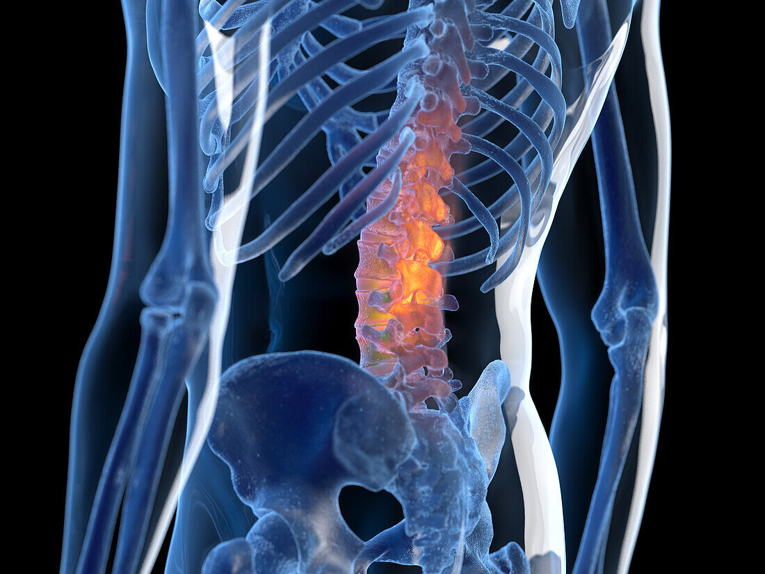 Inflamed back, illustration