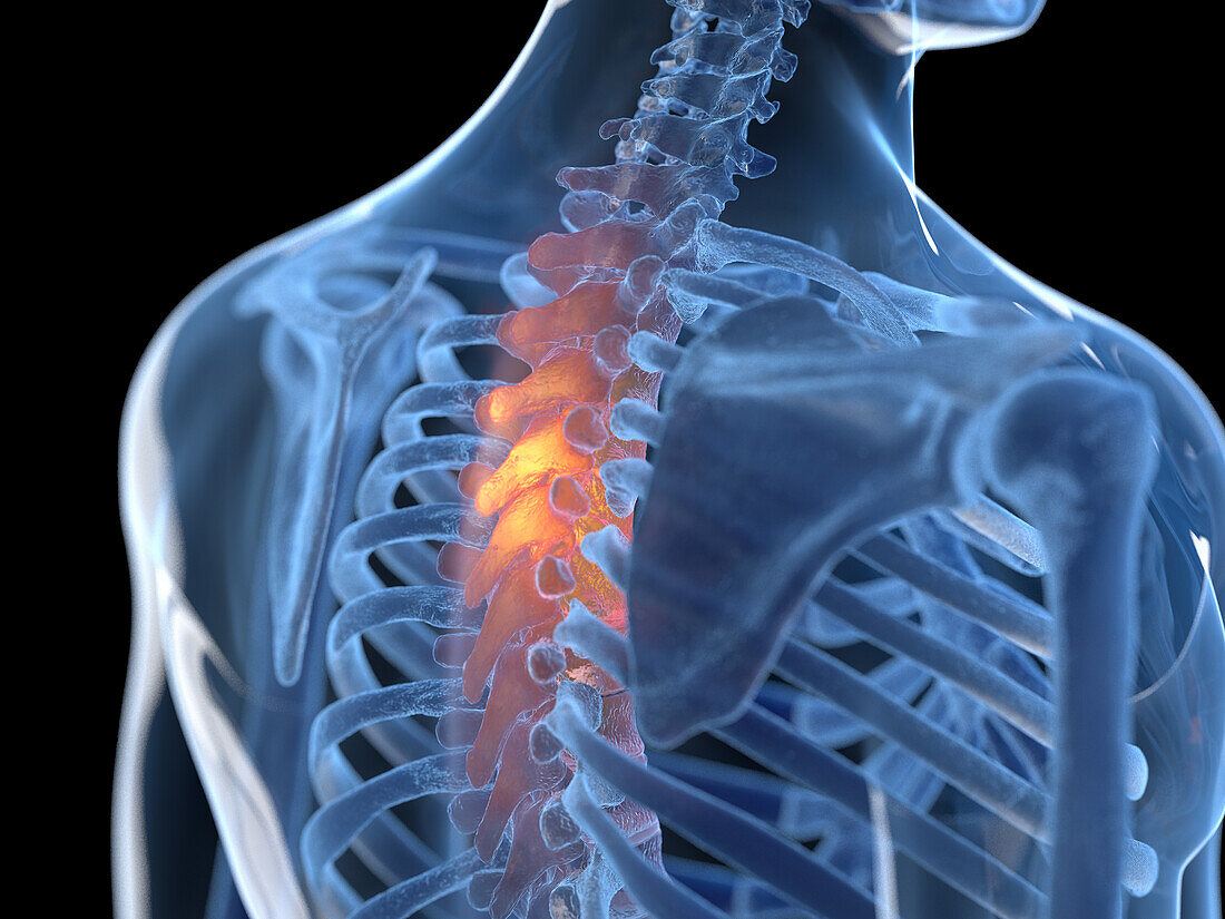 Painful thoracic spine, illustration