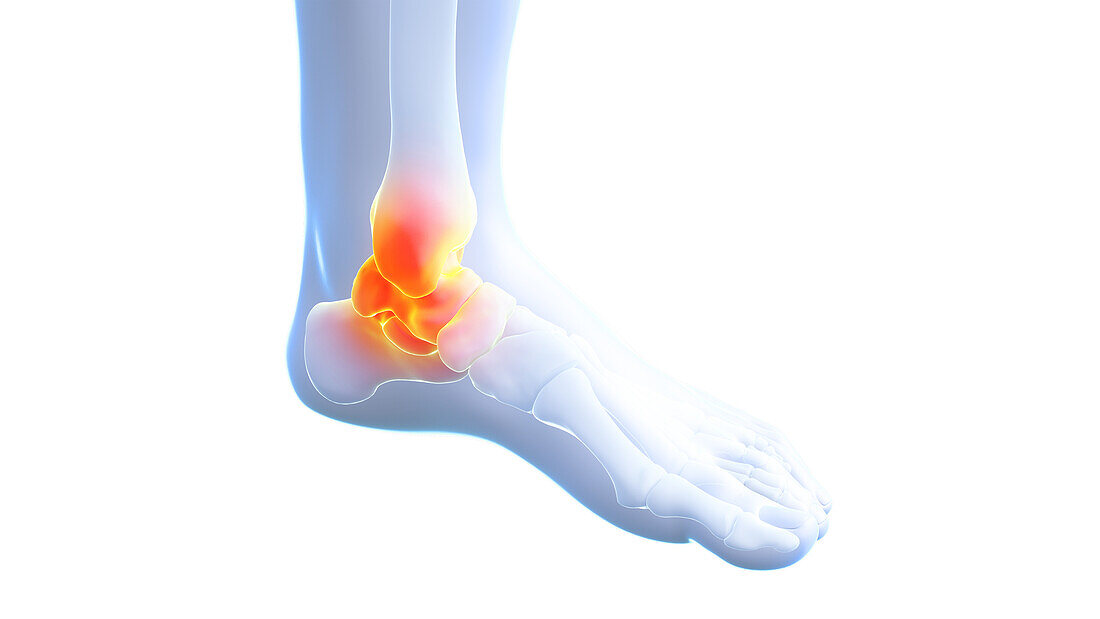Painful ankle joint, illustration