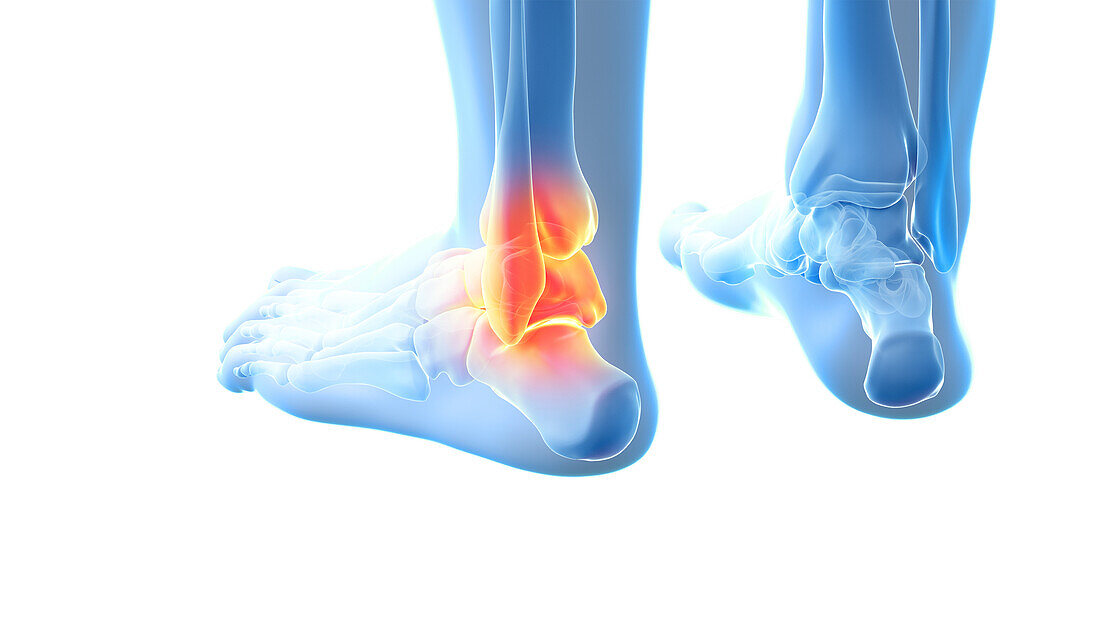 Painful ankle joint, illustration