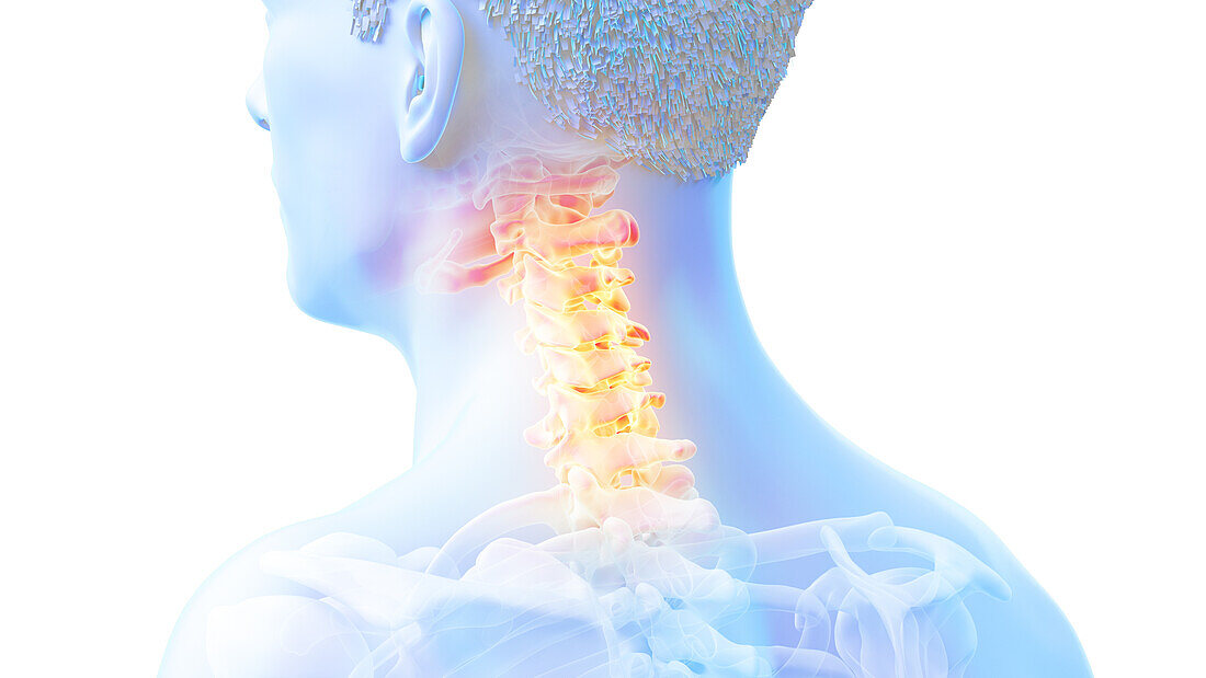 Painful cervical spine, illustration