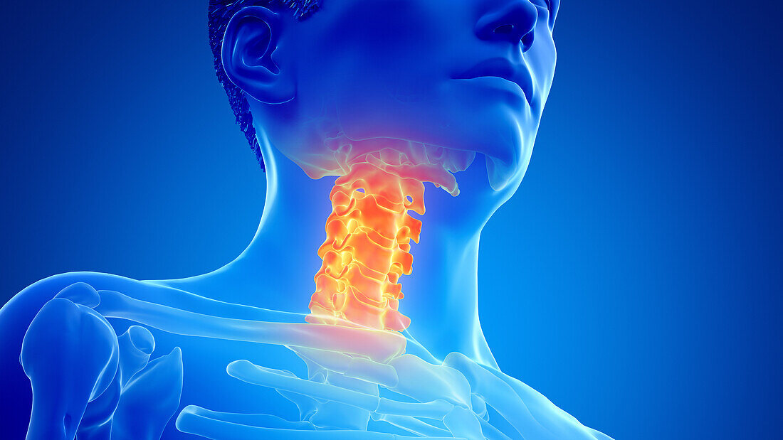 Painful cervical spine, illustration