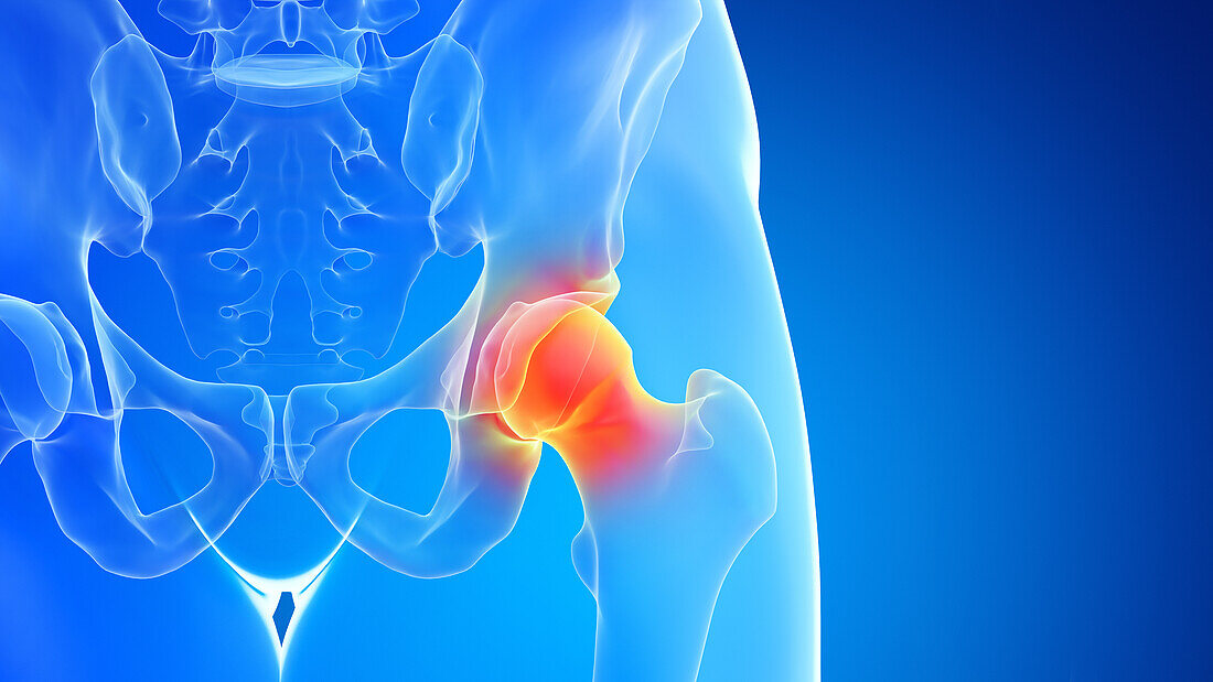 Painful hip joint, illustration