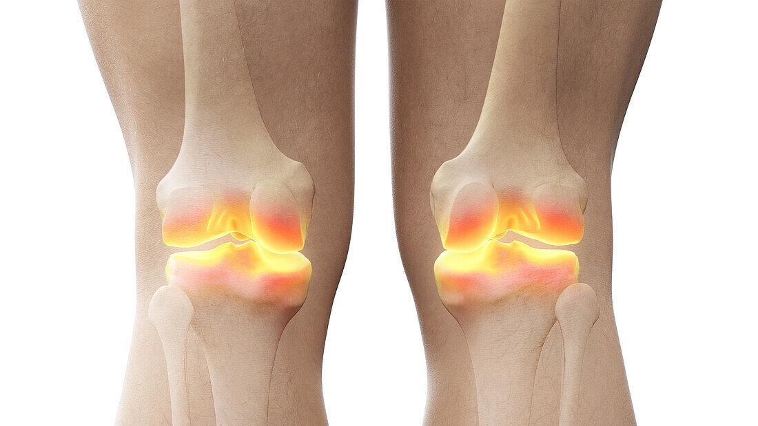 Painful knee joints, illustration