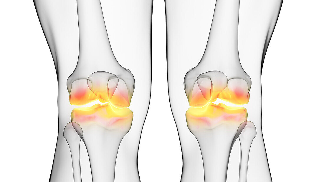 Painful knee joints, illustration