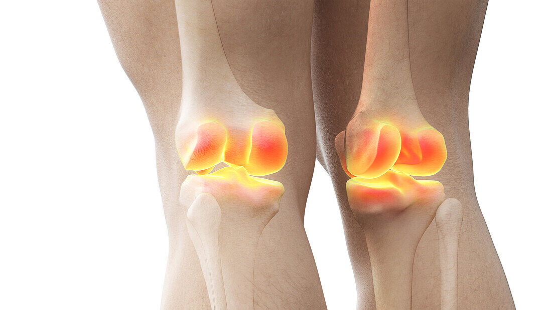 Painful knee joints, illustration