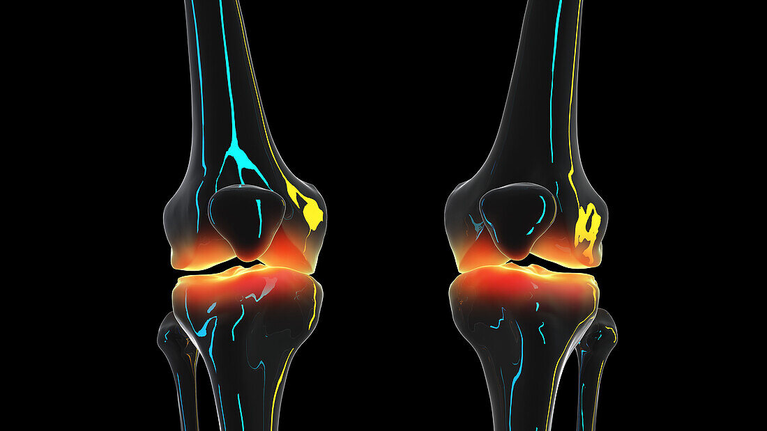 Painful knee joints, illustration