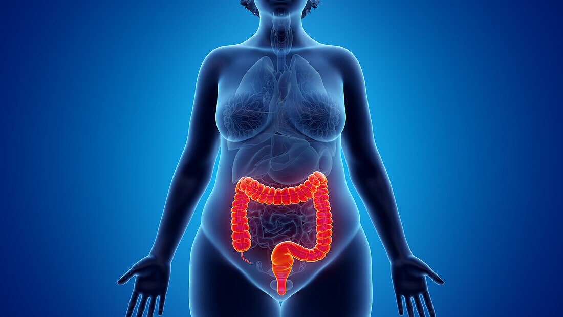 Obese woman's colon, illustration