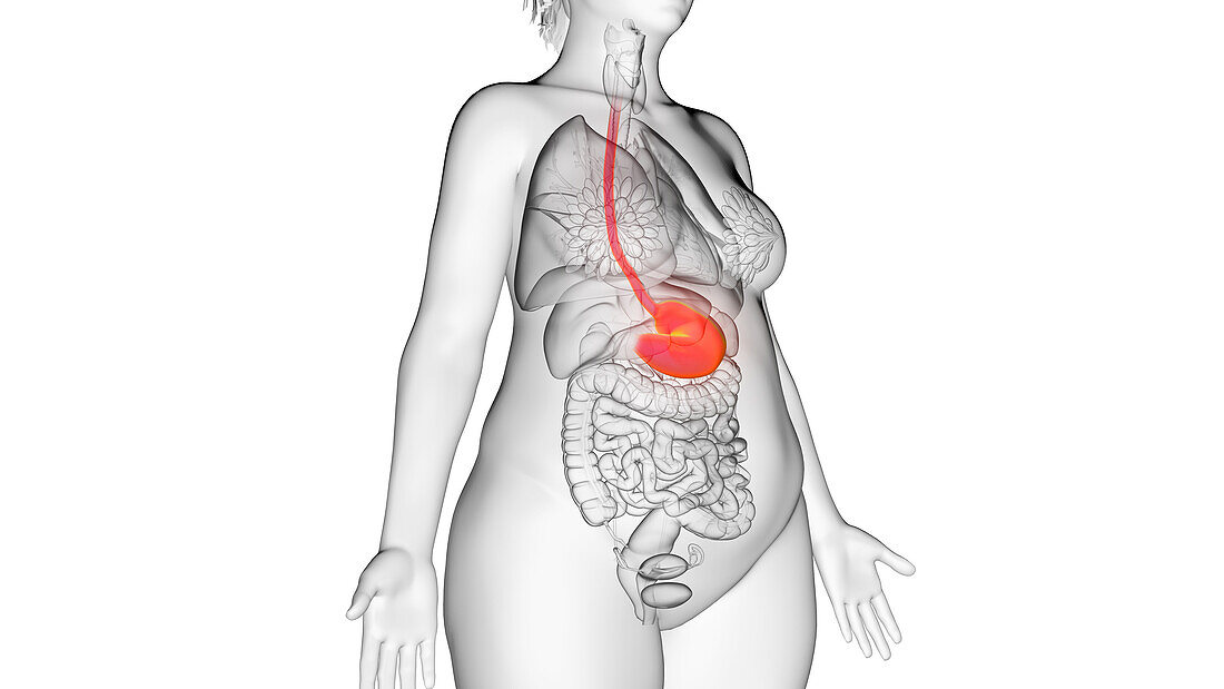 Obese woman's stomach, illustration