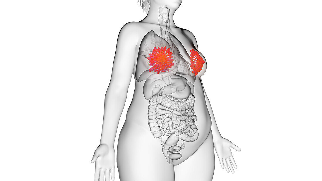 Obese woman's mammary glands, illustration