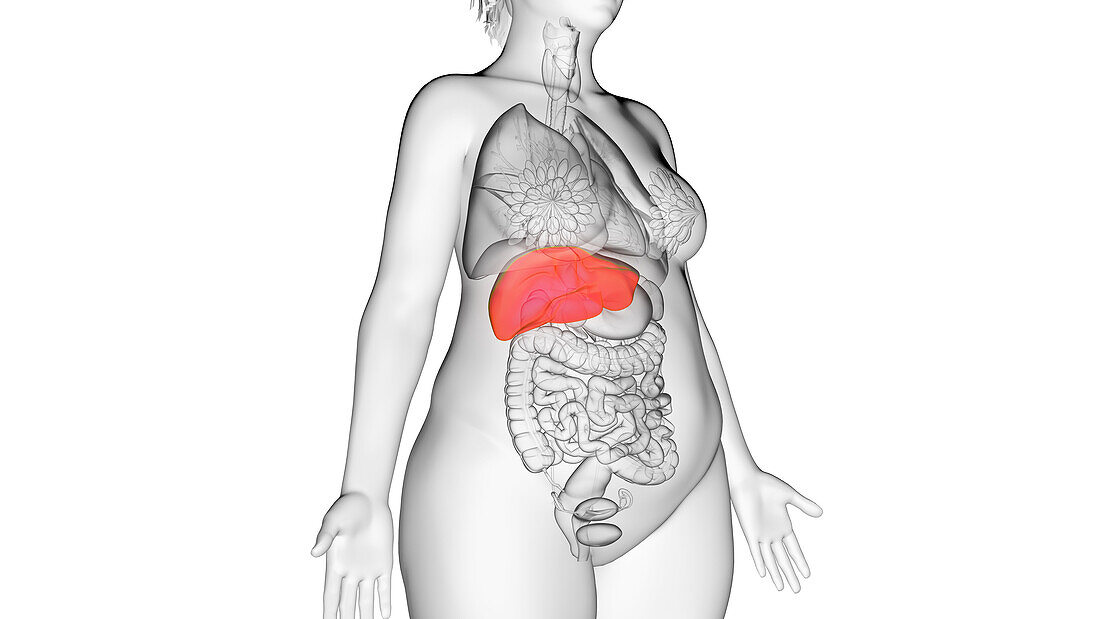 Obese woman's liver, illustration