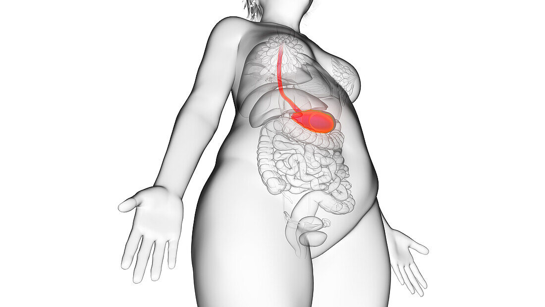 Obese woman's stomach, illustration