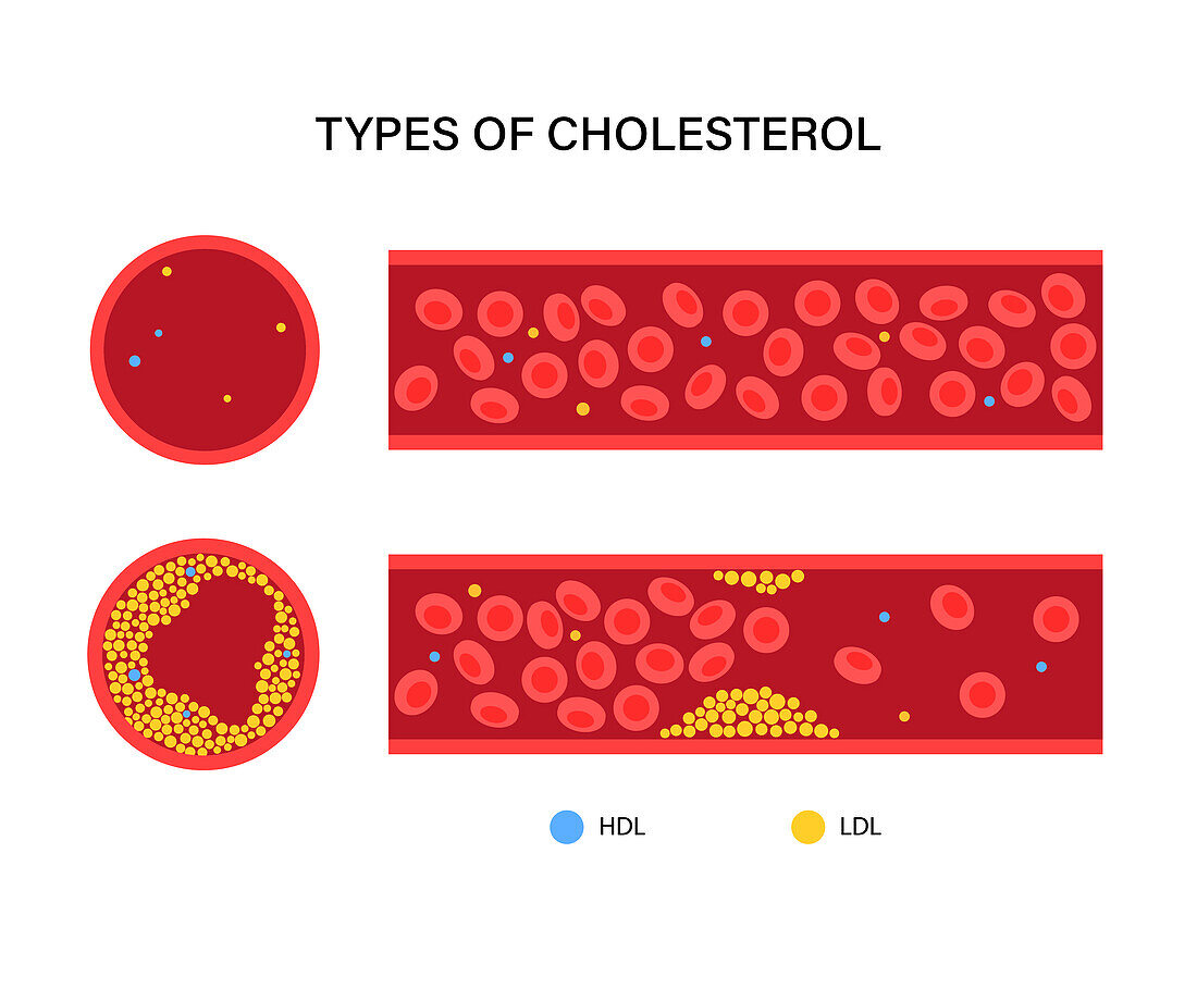 Cholesterol in human blood vessels, illustration