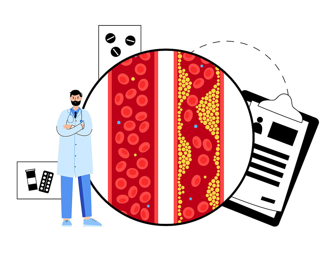 Cholesterol in human blood vessels, illustration