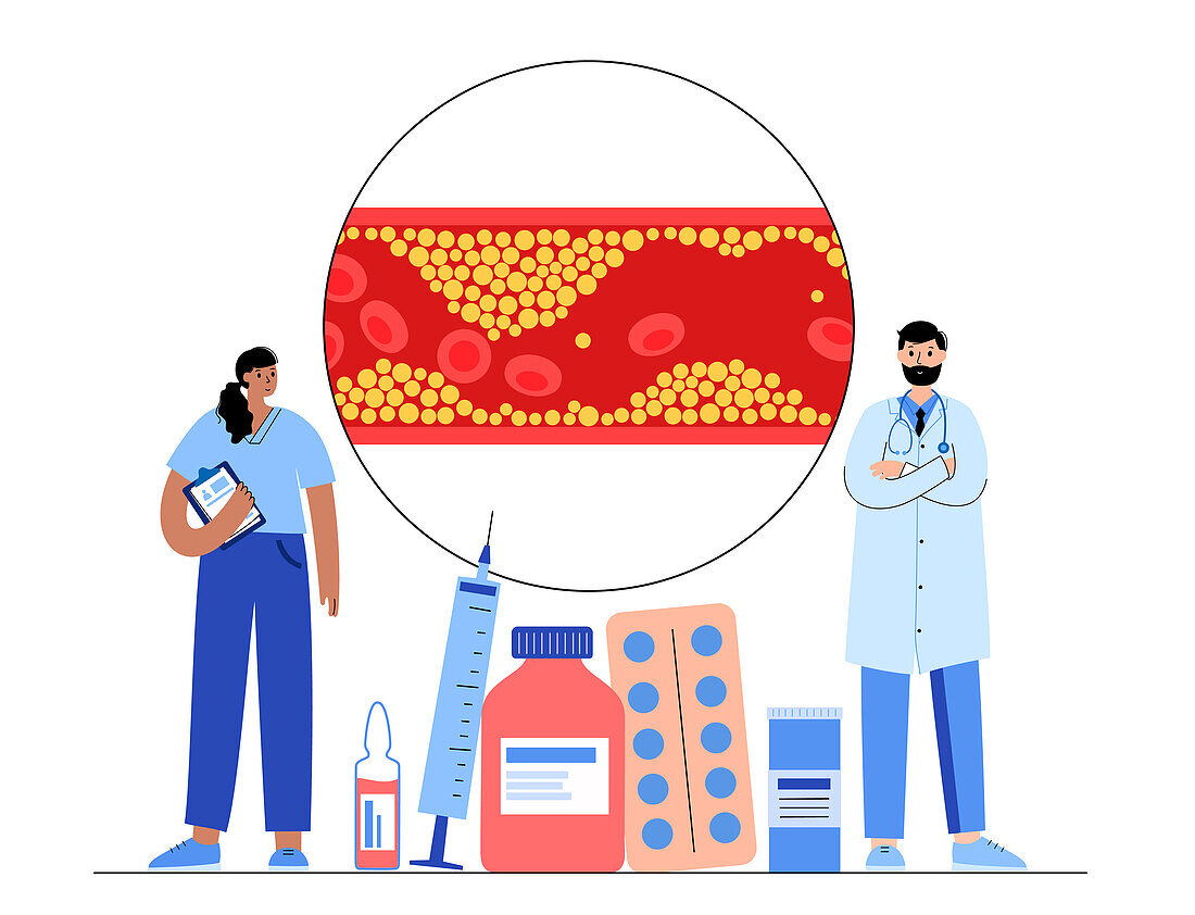 Cholesterol in human blood vessels, illustration