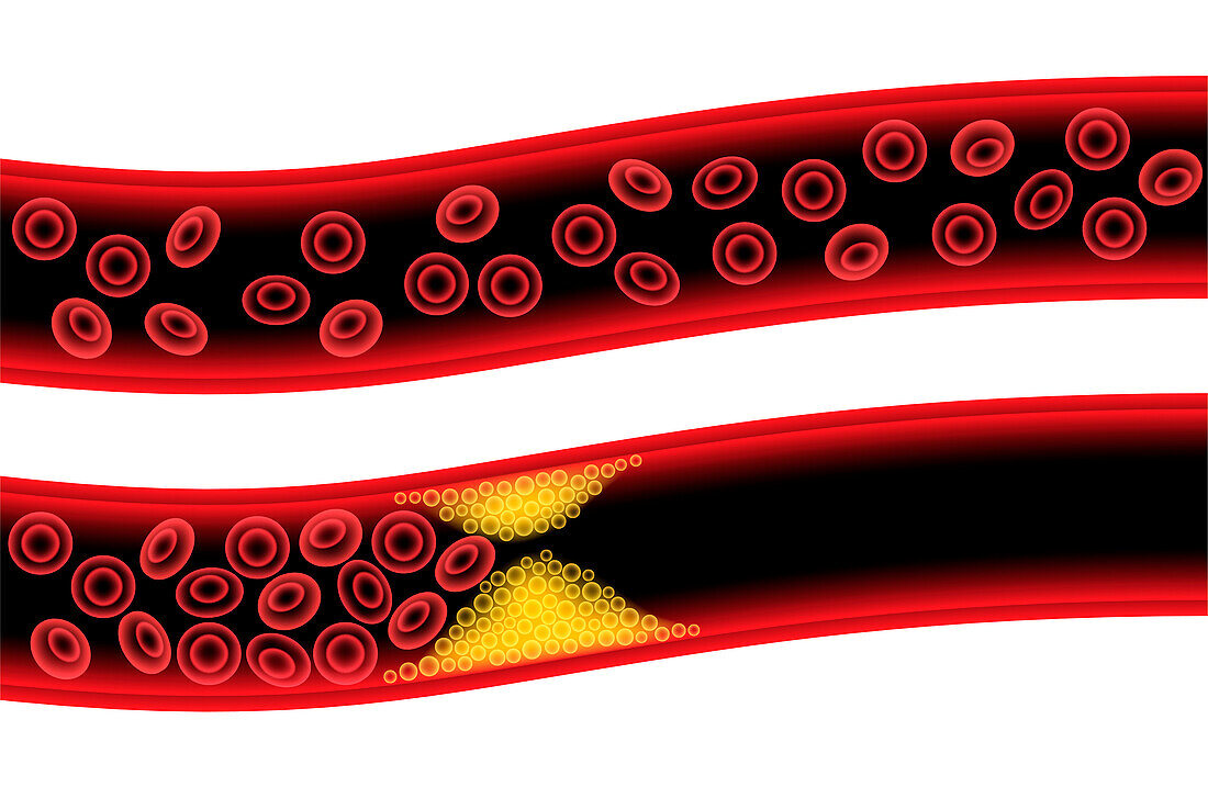 Atherosclerosis, illustration