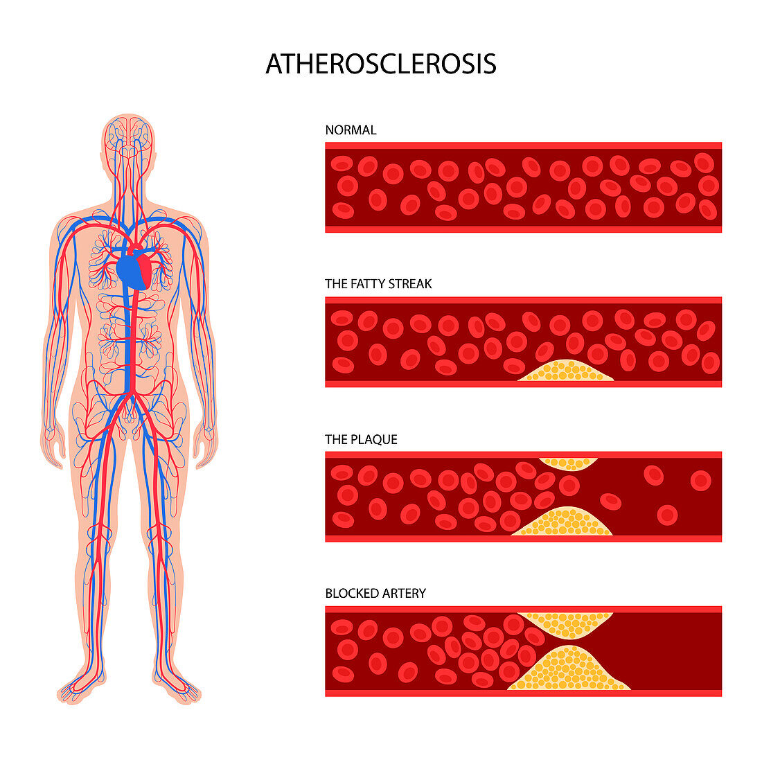 Atherosclerosis, illustration