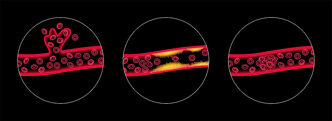 Ischaemic and haemorrhagic strokes, illustration