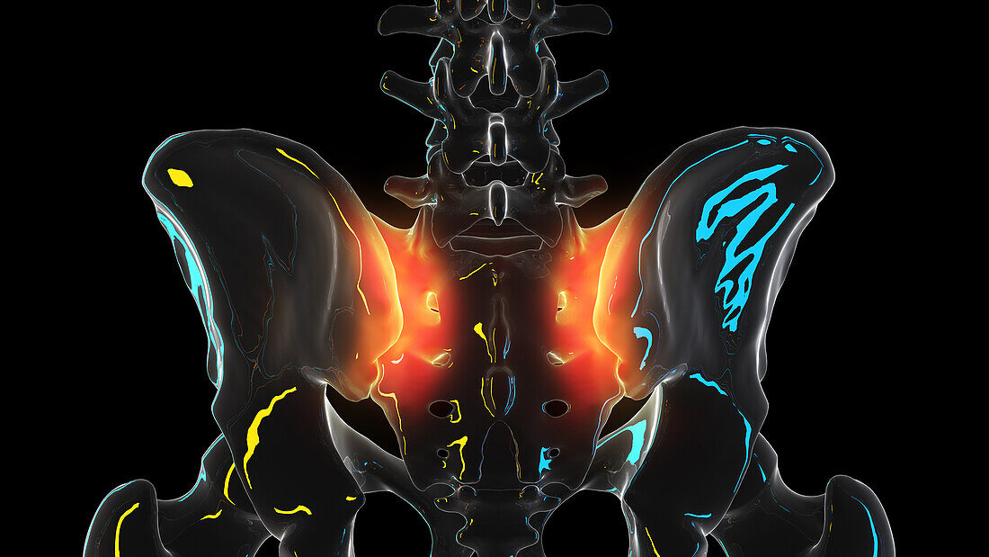 Painful sacroiliac joint, illustration