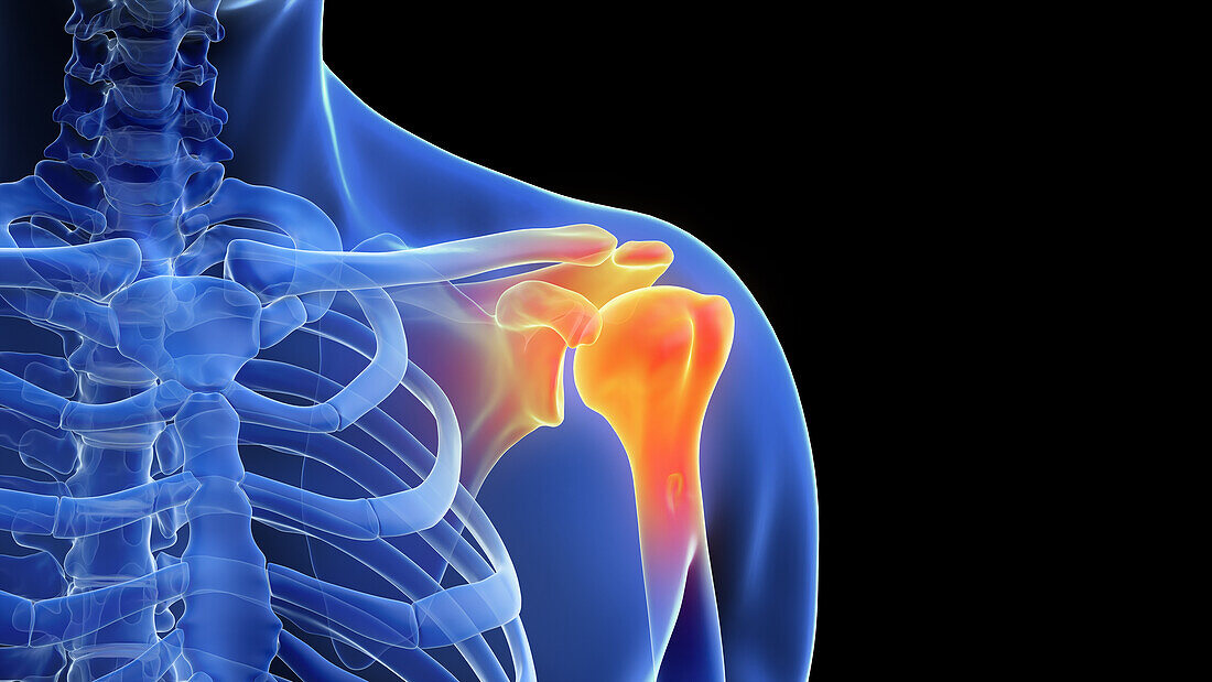 Painful shoulder, illustration