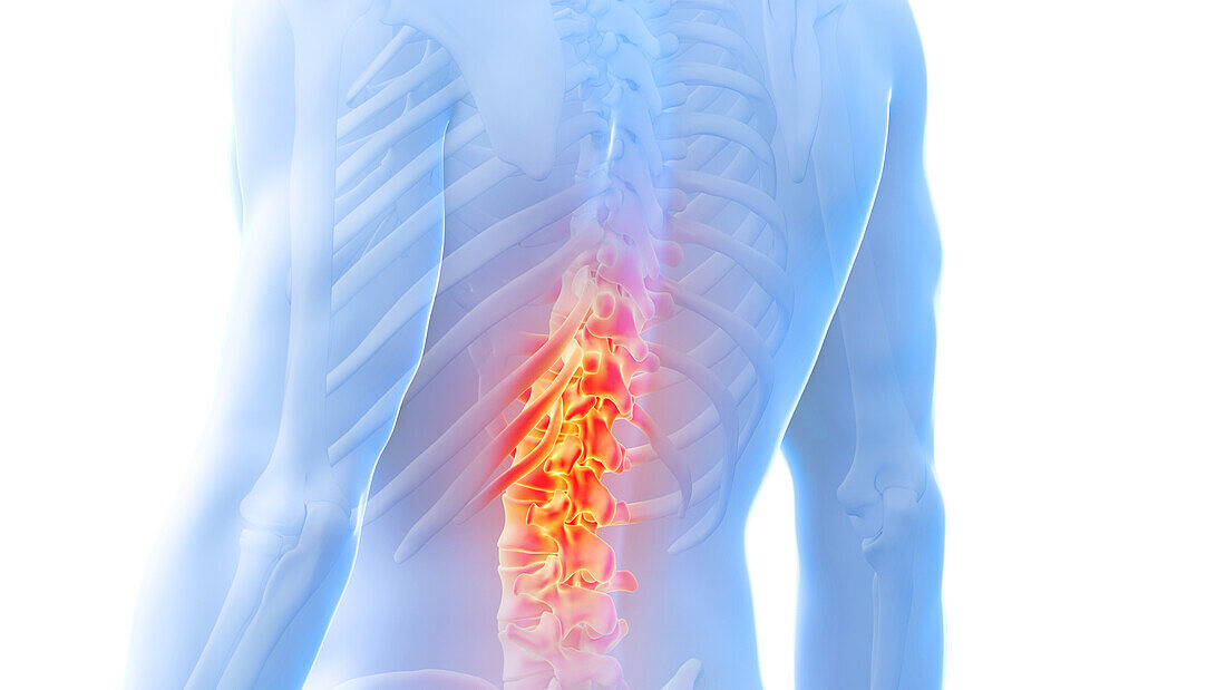 Painful spine, illustration