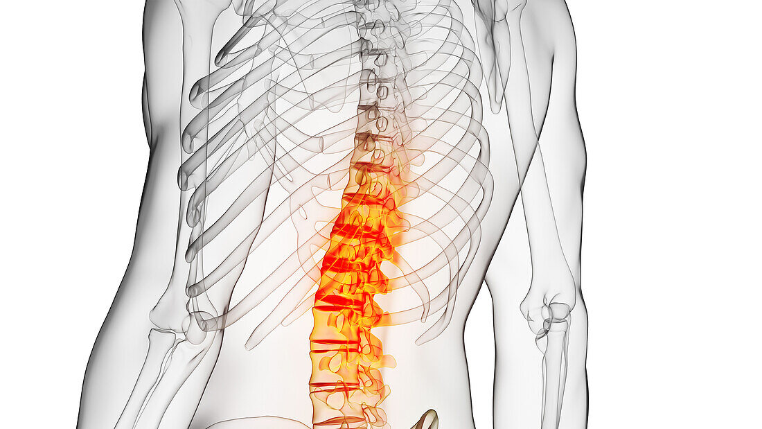 Painful spine, illustration