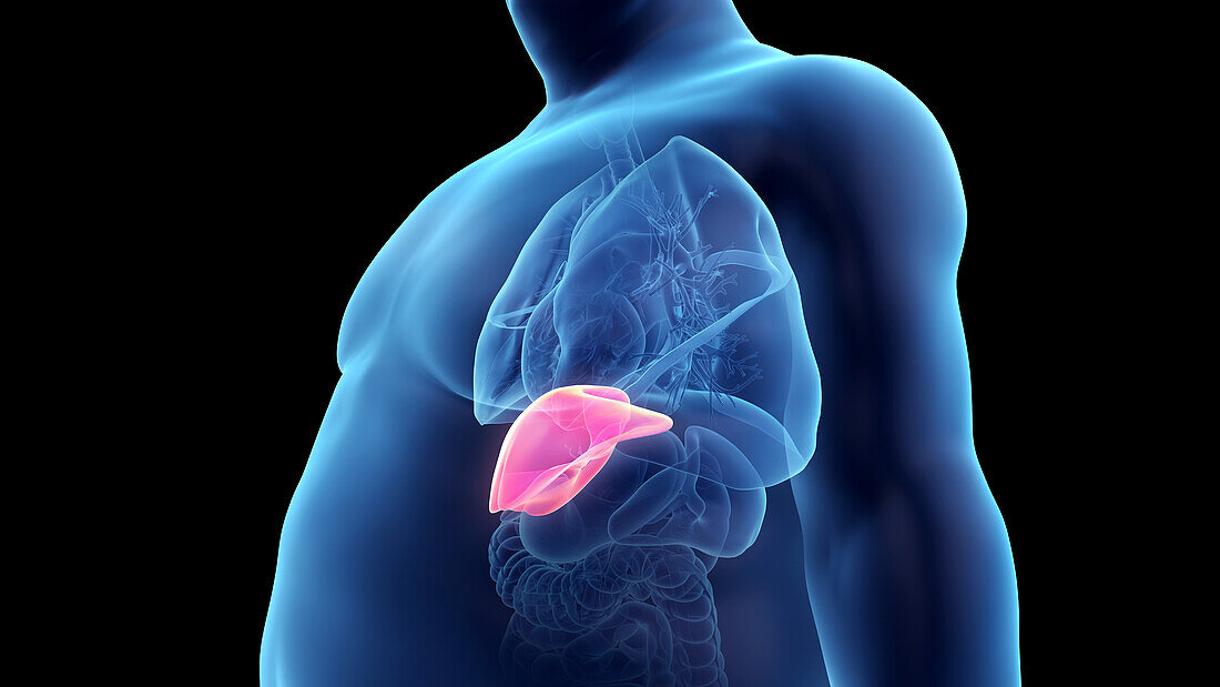 Obese man's liver, illustration