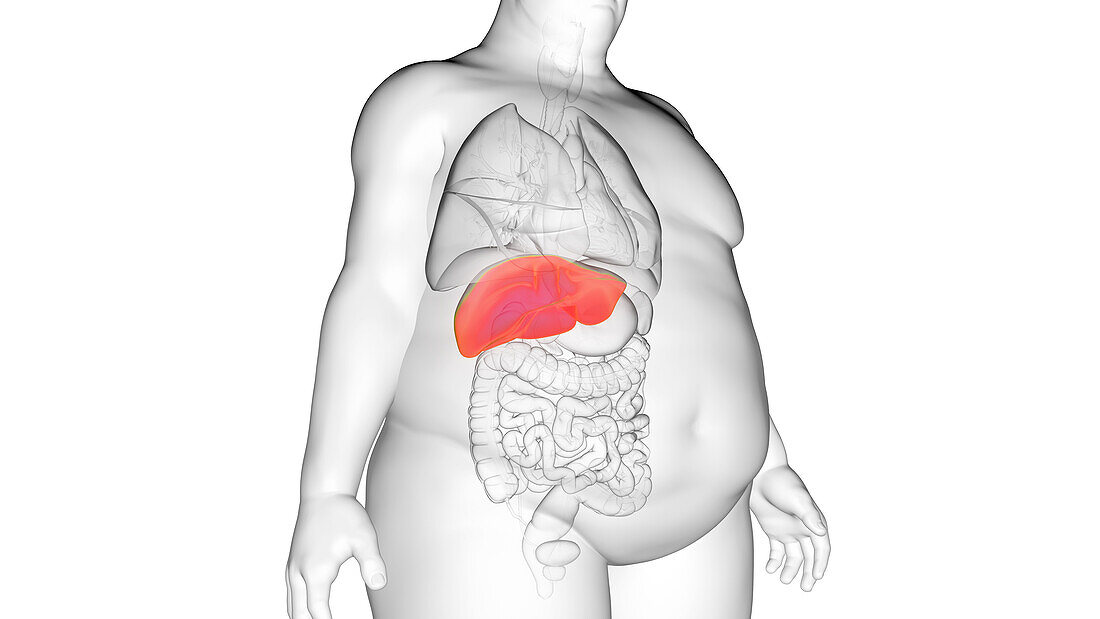 Obese man's liver, illustration