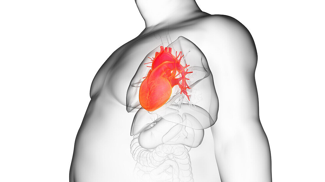 Obese man's heart, illustration