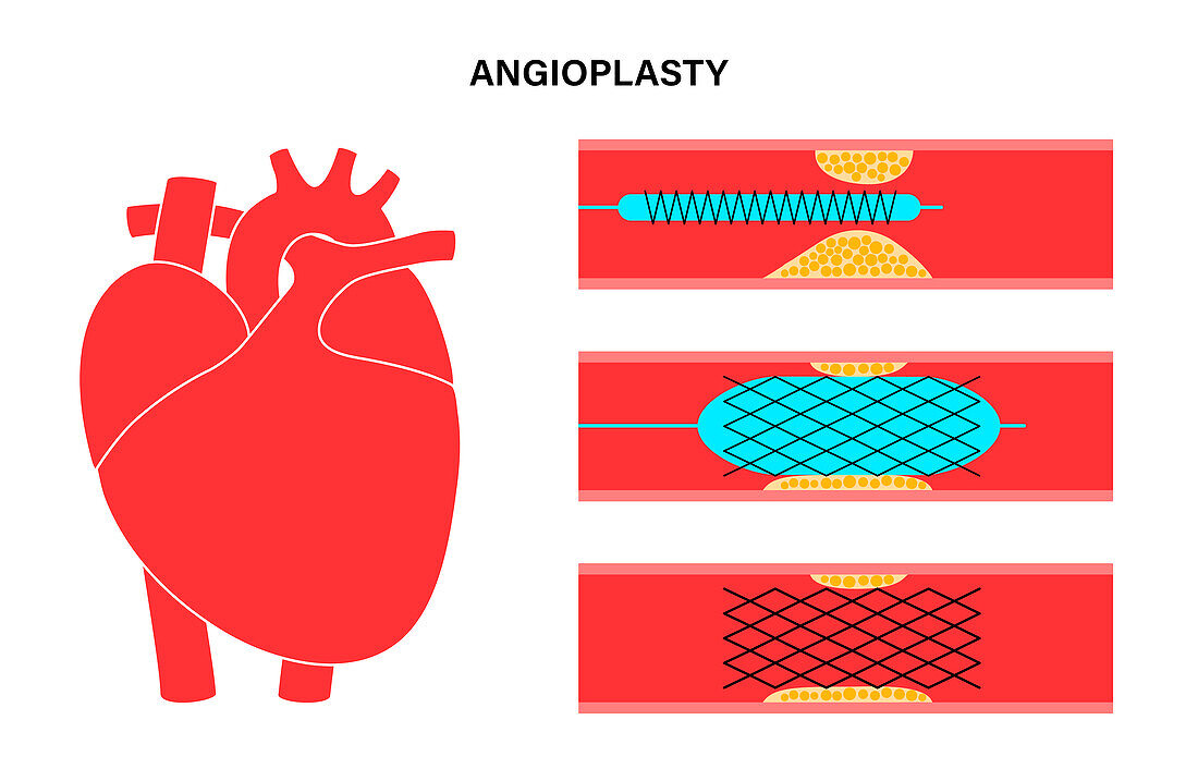 Angioplasty, illustration