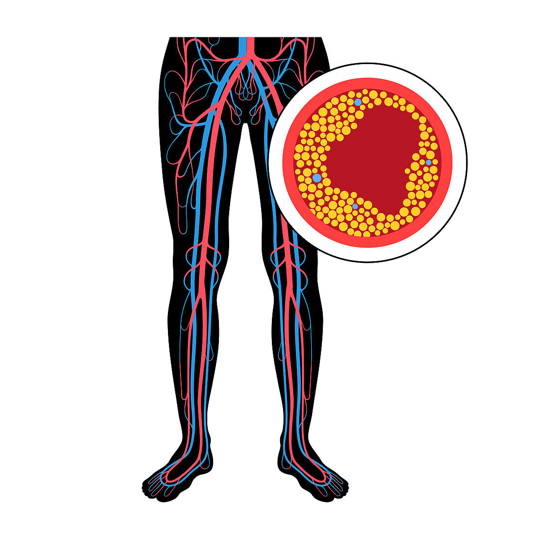 Peripheral artery disease, illustration