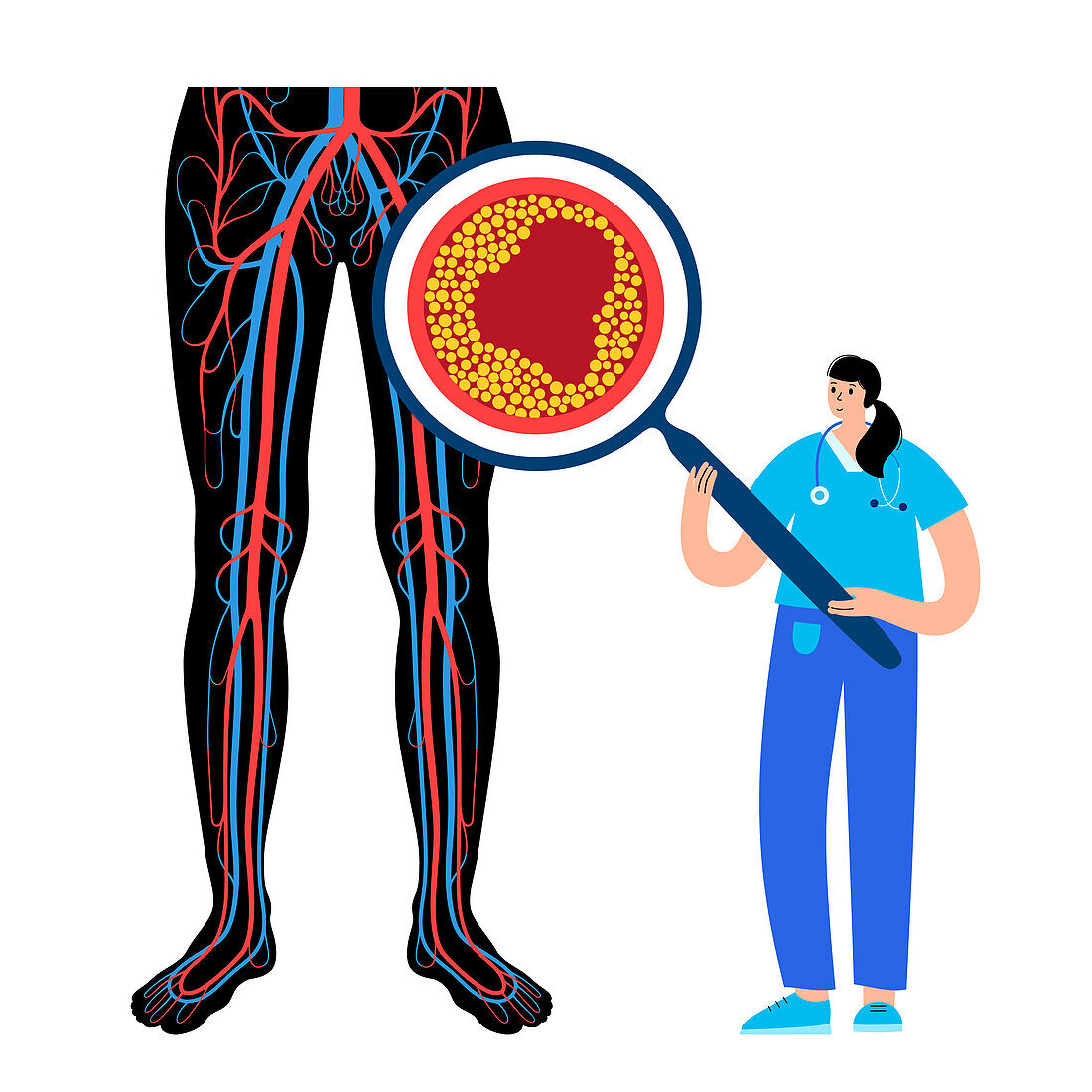 Peripheral artery disease, illustration