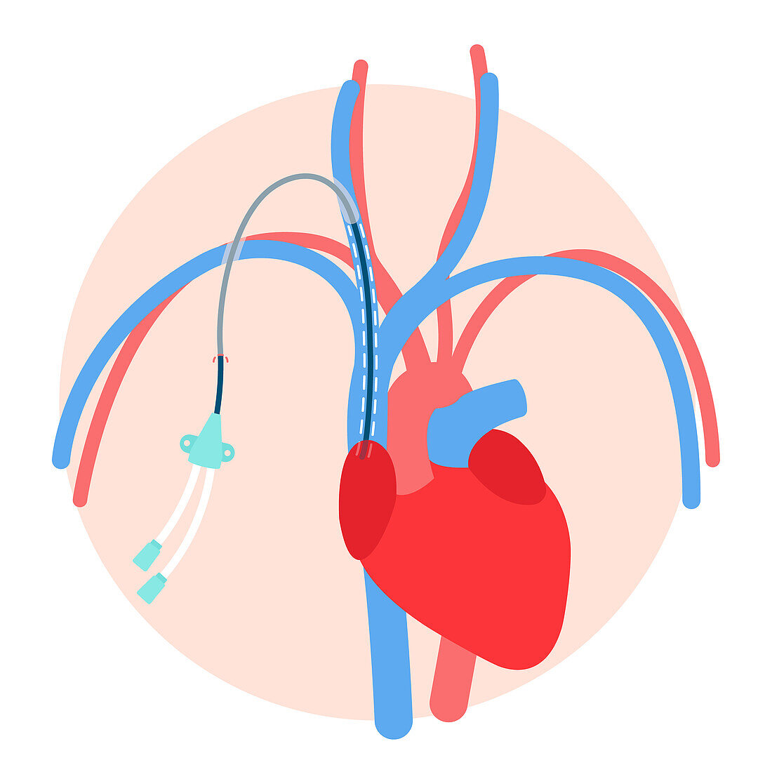 Central venous catheter, illustration