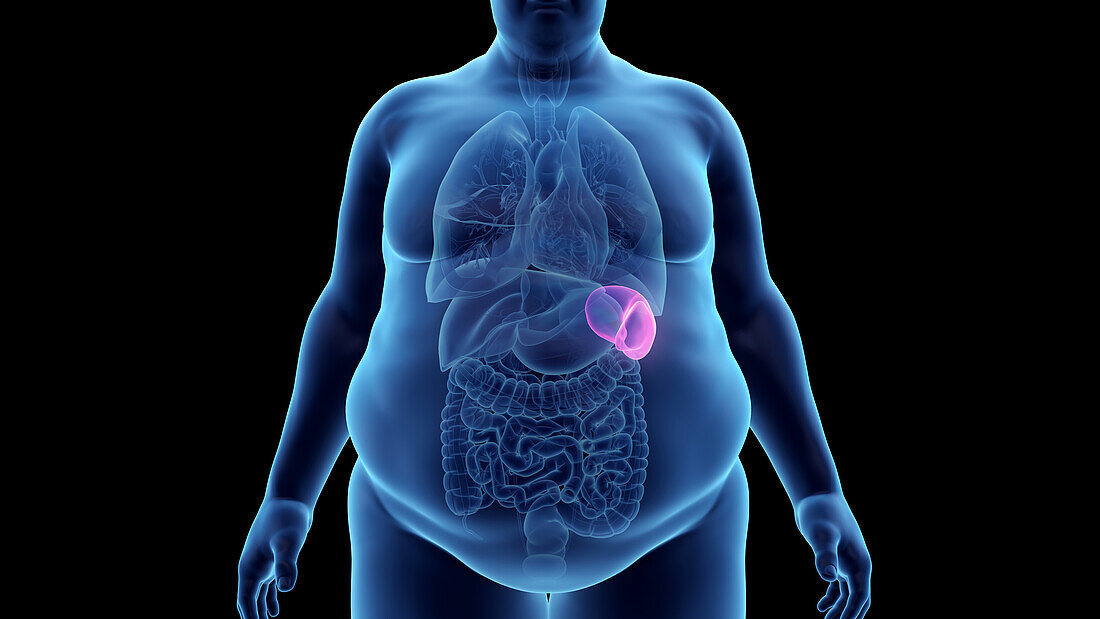 Obese man's spleen, illustration