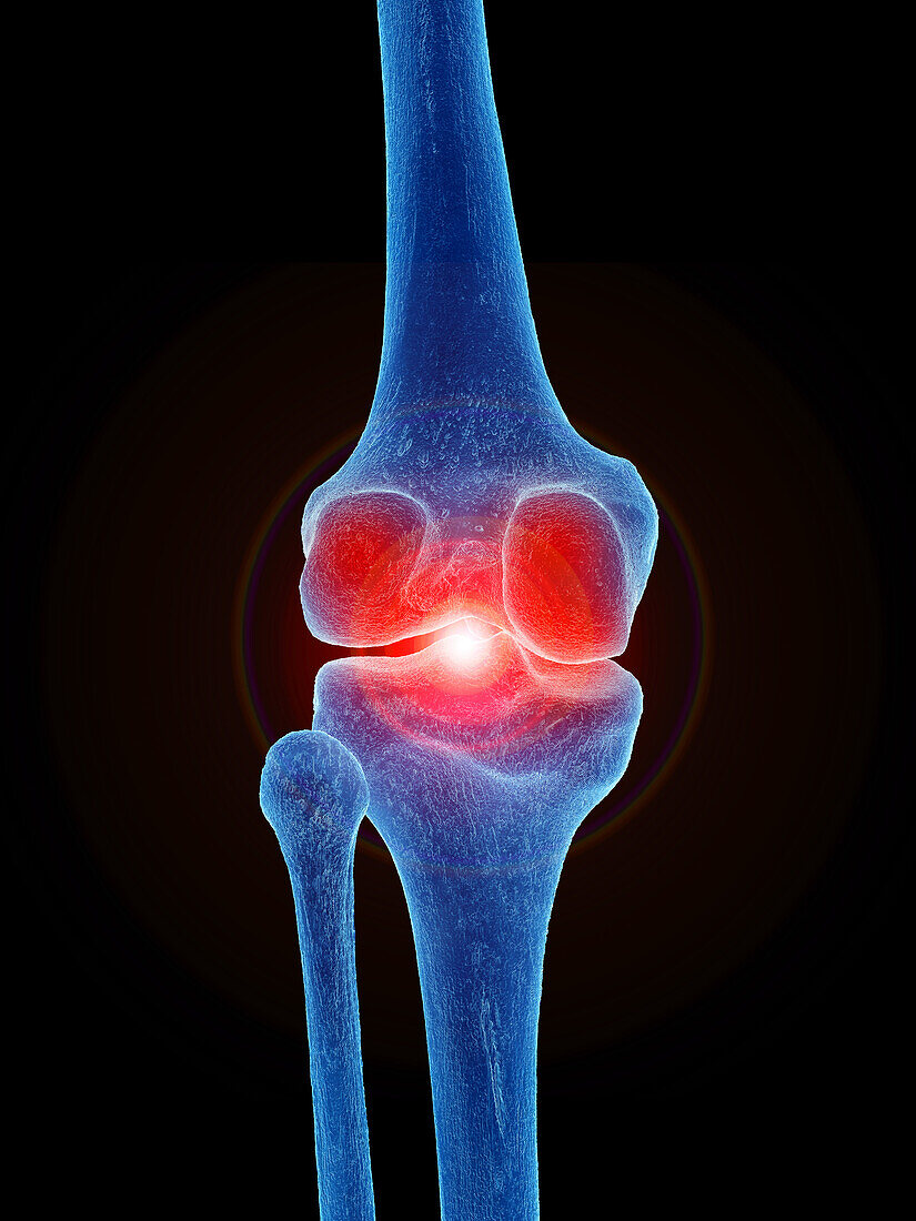 Painful knee joint, illustration