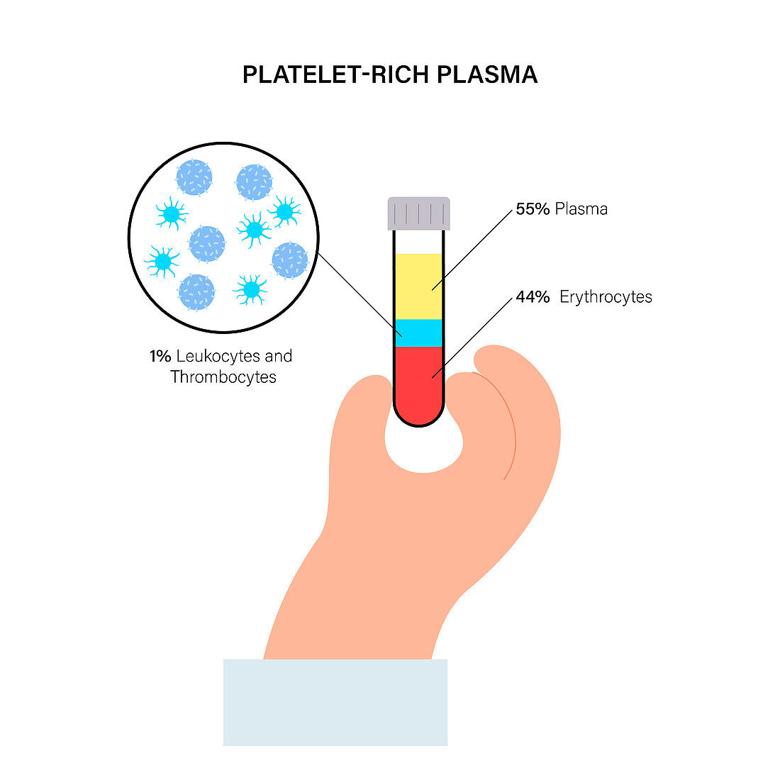 Platelet rich plasma, illustration